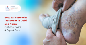 Best Varicose Vein Treatment in Delhi and Noida: Options, Costs & Expert Care