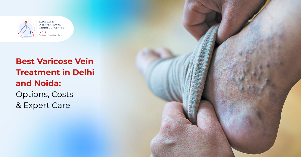 Patient undergoing best varicose vein treatment in Delhi and Noida for swollen leg veins