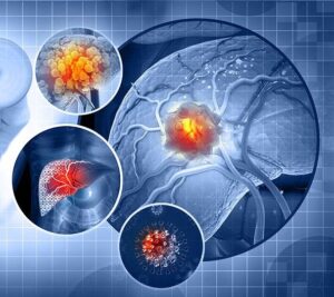 Interventional Oncology