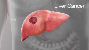 Liver Tumors