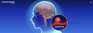 Aneurysm Treatment