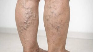 Varicose Veins